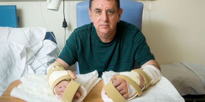 UK's First Double Hand Transplant a Success