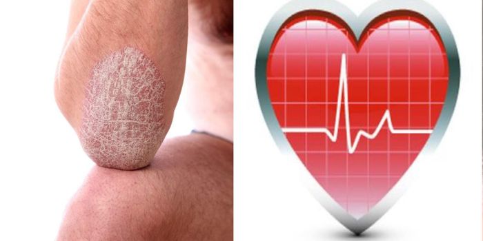 Psoriasis and Heart Disease: What do the two have in common?