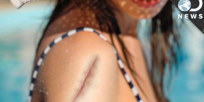 Here's Why Scars Get Sunburnt Easily and Don't Grow Hair