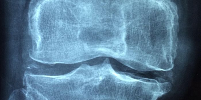 Collection of Immune Cells Drive Rheumatoid Arthritis Progression
