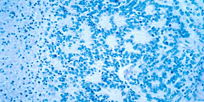 FDA Approves Pediatric Cancer Drug