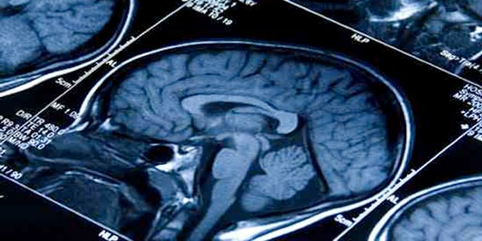 Malaria Drug Successfully Shrank Aggressive Brain Tumor