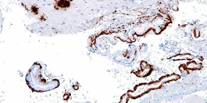 Connections Growing Stronger Between Immune Function and Alzheimer's Disease