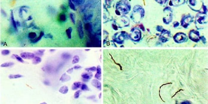 Inflammation as Source of Neurologic Changes with Lyme Disease