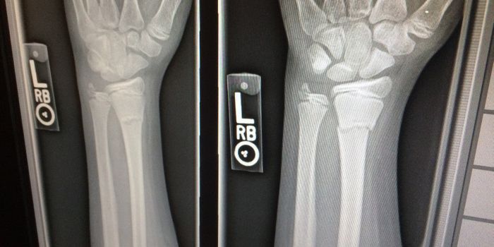 High Blood Pressure Weakens Bone Structure and Can Lead to Osteoporosis