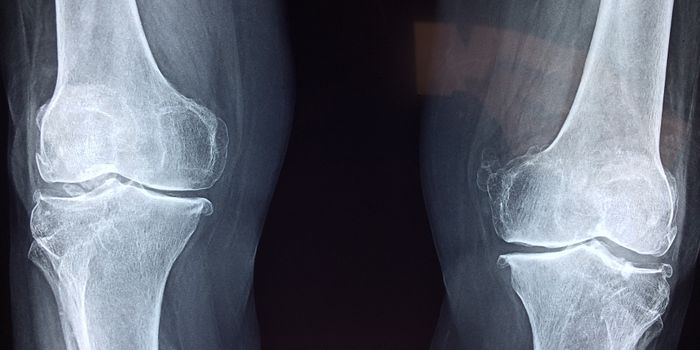 A Promising Biomarker for Osteoarthritis Has Been Found