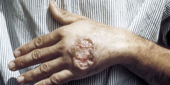 Dysbiosis in the Skin Microbiome can Promote Inflammation