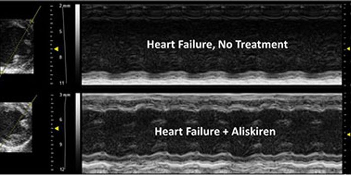 Drug Increases Survival Rates for Heart Failure Patients