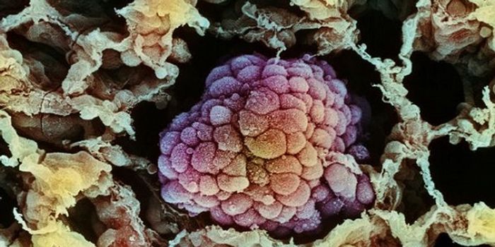 Using Photodynamic Therapy to Kill Hard-to-Reach Tumors