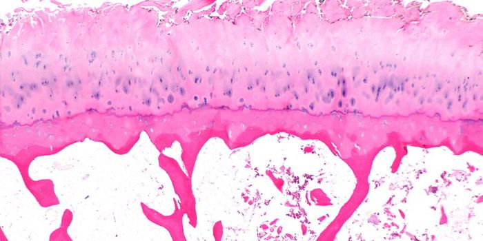 Three-Dimensional Diagnosis of Osteoarthritis
