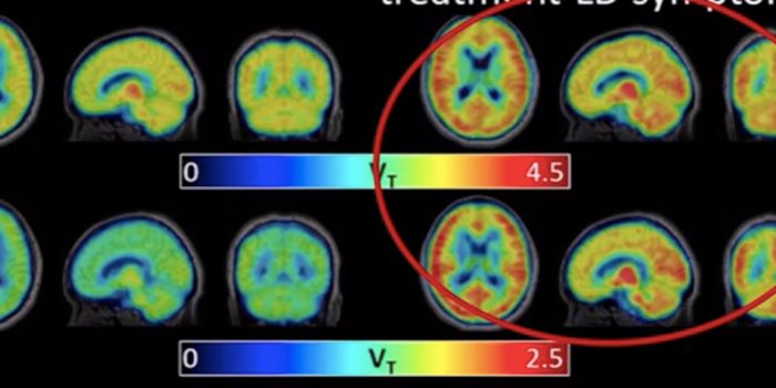 Brain Scans Reveal Inflammation in Post-Treatment Lyme Disease Syndrome