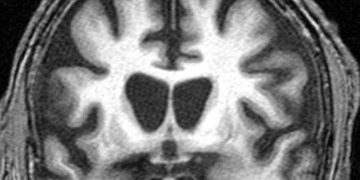 Nrf2 Role in Protein Regulation may aid Neurodegeneration Therapeutics