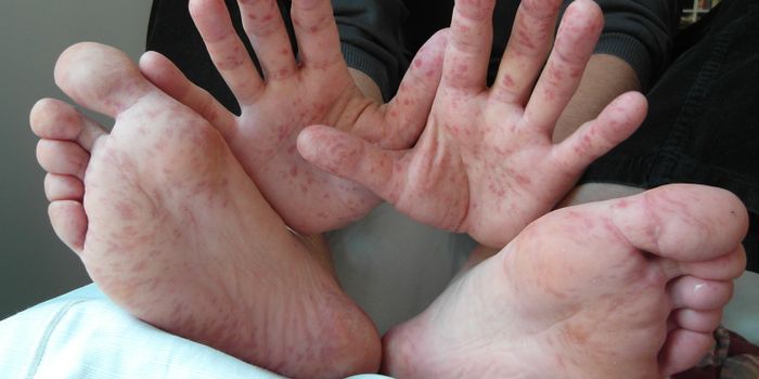 Diagnosed: Hand, Foot, And Mouth Disease Strikes College Students