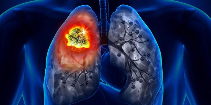 New Technology Detects Early-Stage Lung Cancer