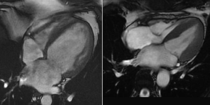 New MRI Technology Detects Any Disease Involving Inflammation