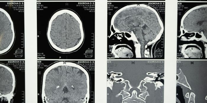 Almost Half of Older People Die with Dementia
