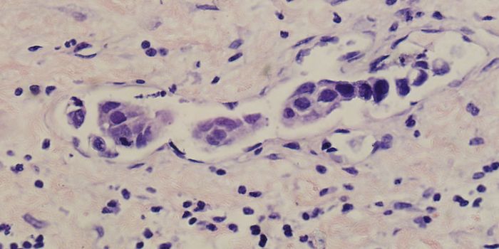 To Treat Bladder Cancer, You Need Immune Cells