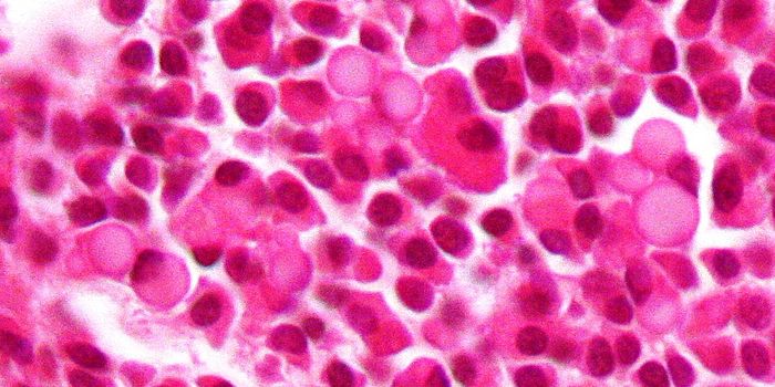 Cancer Drug Raises Risk of Cardiovascular Toxicity