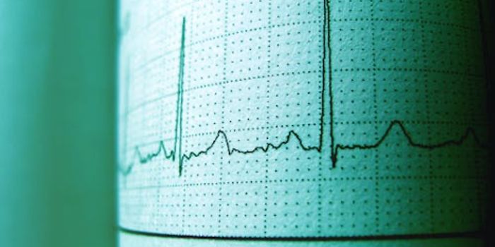 Atrial Fibrillation Tied to Dementia Risk