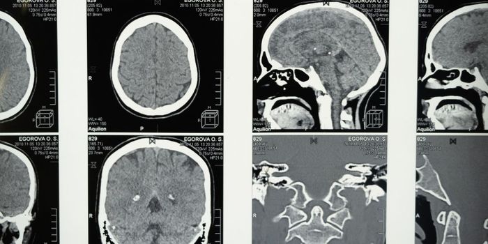 New Clue for Why More Women Develop Alzheimer's than Men