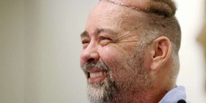 First Simultaneous Skull-Scalp, Kidney, and Pancreas Transplant