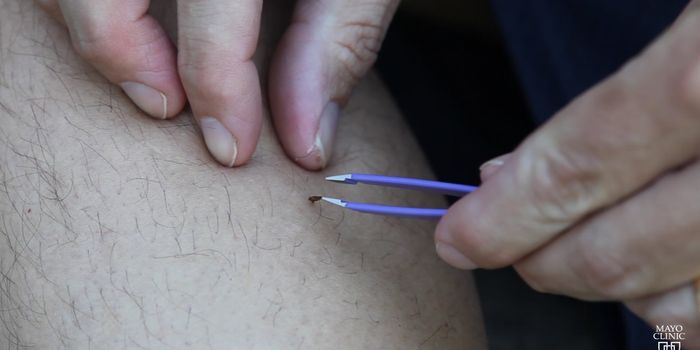 Parasitic Disease Expert Discusses the Best way to Remove a Tick