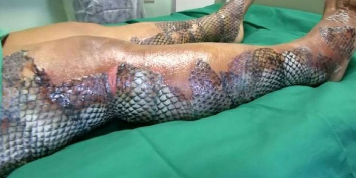 Fishy Business: Tilapia Skin Saves Burn Victims