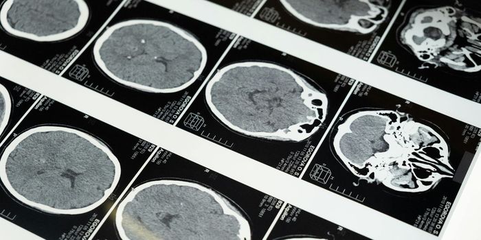 TBI in Older Adults Linked to Higher Rates of Dementia