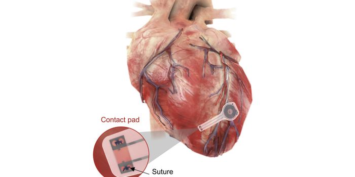 Temporary Pacemaker Can Dissolve Away