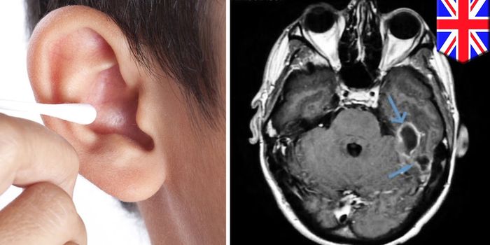 Brain Infection Develops After Man Uses Cotton Swabs