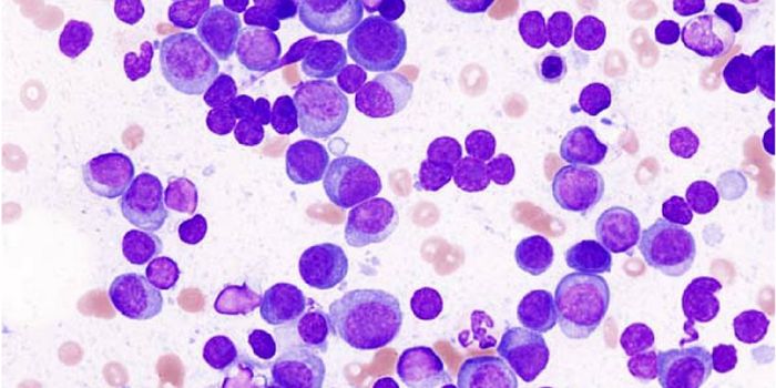 The Microfluidic Device: Future Replacement for Bone Marrow Biopsy in Multiple Myeloma