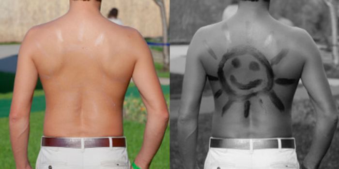 ‘Sunscreen Gene' Could Lead To New Therapy For Melanoma