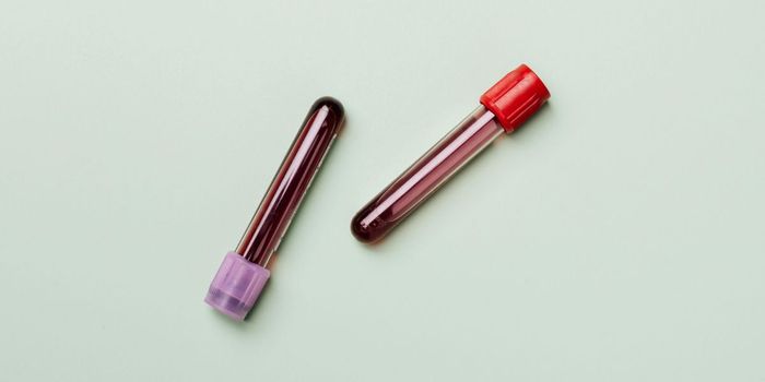 Alzheimer's Blood Test Outperforms Traditional Diagnostics