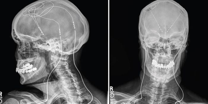 Brain Pacemaker in Frontal Lobe Slows Alzheimer's in New Study