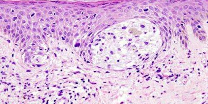 Discovery of Biomarker Target for Melanoma