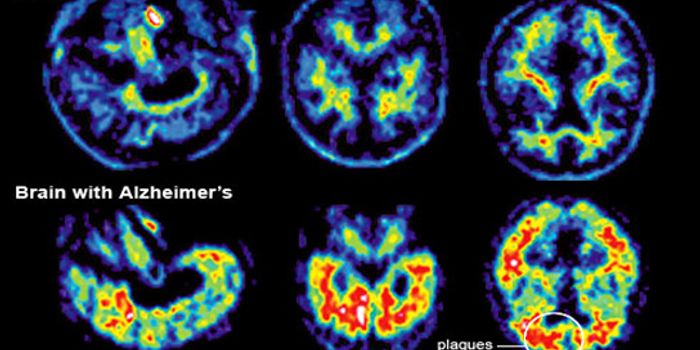 Some Dementia Patients Lack Common Signs