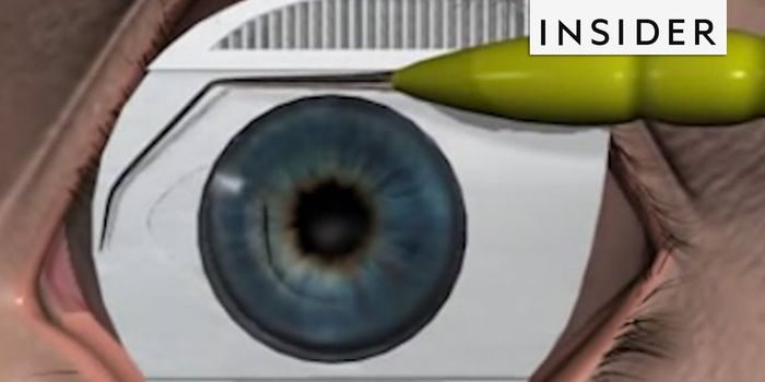 How Does LASIK Correct Vision?