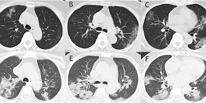 Images of Lungs from COVID-19 Patients Reveal Diagnostic Significance