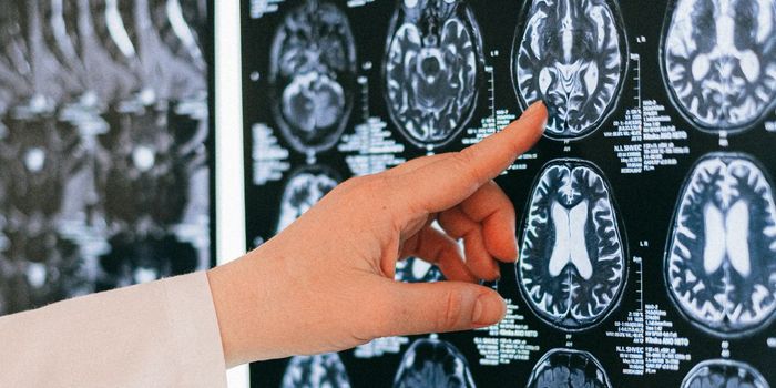 Implantable Pump Delivers Chemotherapy Directly to the Brain