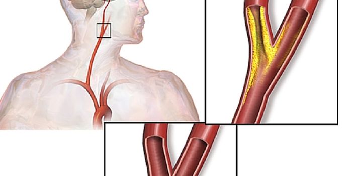 Experience Matters In Stroke Care