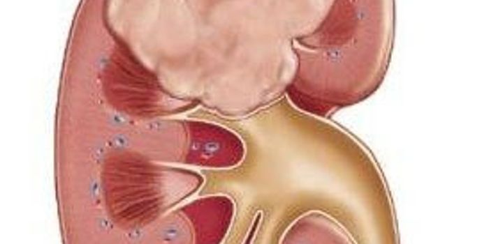 Biomarker Predicts Kidney Cancer