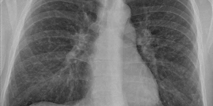 Sarcoidosis: Severe Infections and Complications