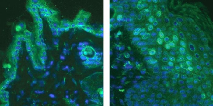 Severe Poison Ivy Itch Relieved with Antibody