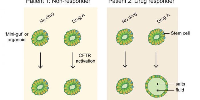 Mini-guts can Personalize Cystic Fibrosis Treatment