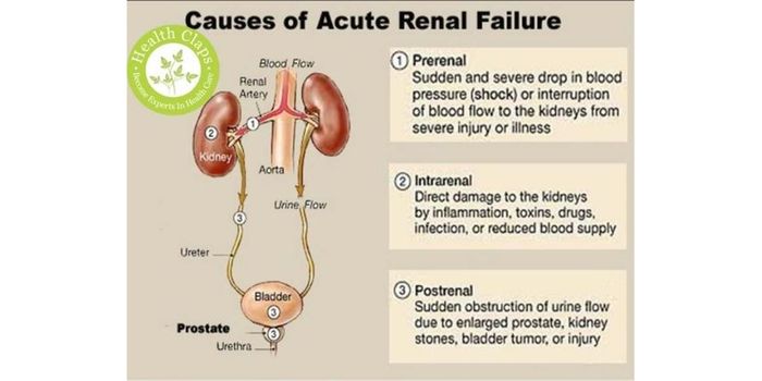 Acute Kidney Injury: Classification, Diagnosis, and Management