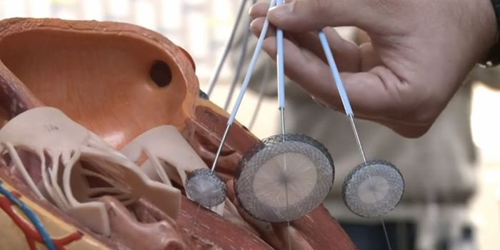 Bolivian women weave devices to repair children's heart defects