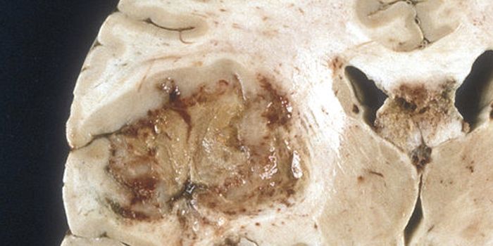 Protecting Against Glioblastoma