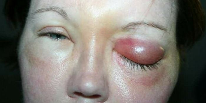 A Parasite Burrowed into Woman's Cornea & Left Her Blind