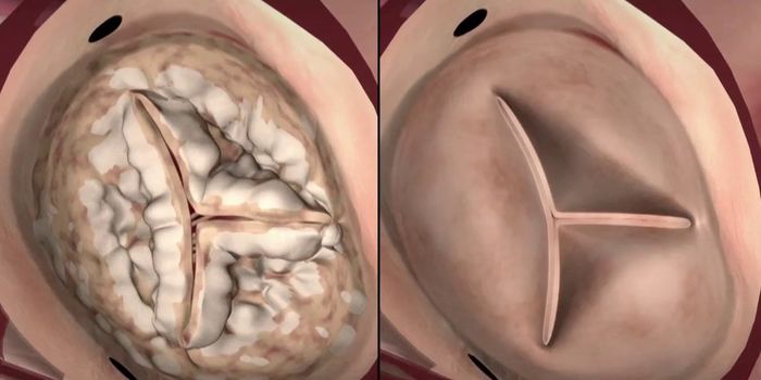 A Novel Drug for Slowing the Progression of Heart Valve Disease