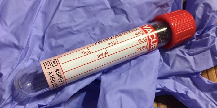 Questions About a New Direct-to-Consumer Alzheimer's Diagnostic